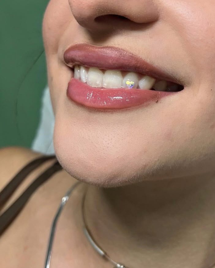 Sonrisa con una gema dental en forma de corazón